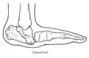 Charcot Eklemi Belirtileri ve Tedavisi